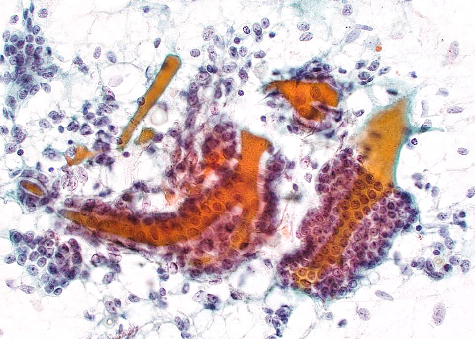 Fig 711 Malignant Epithelial Myoepithelial Carcinoma Emc University Of Wisconsinmadison 7293